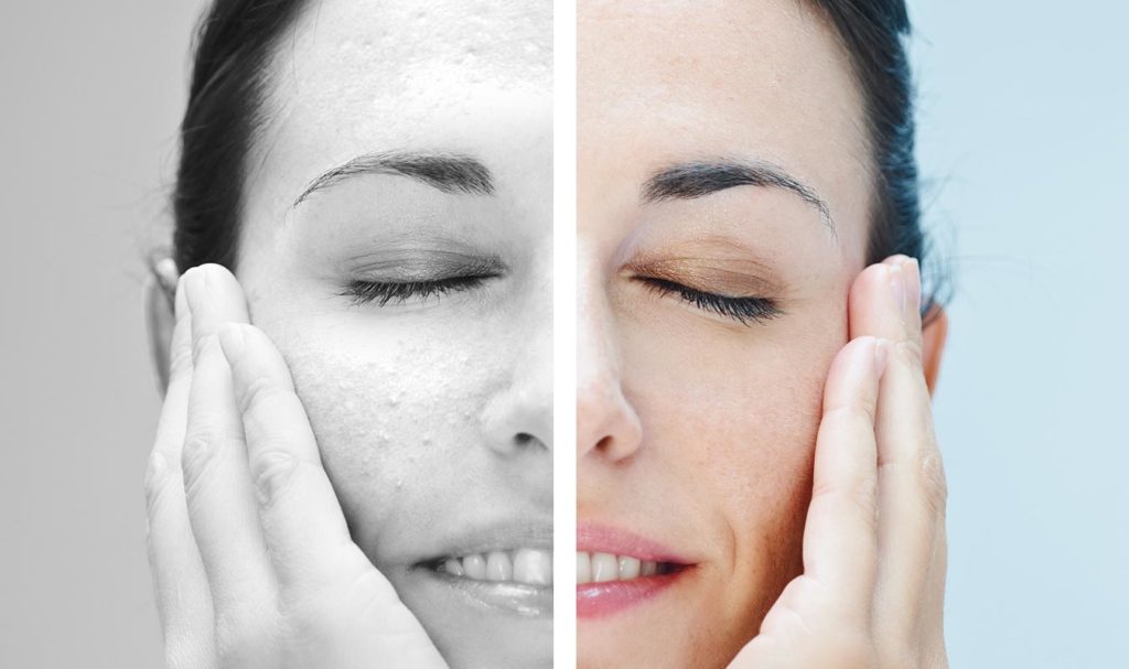 comment enlever les microkystes au visage naturellement