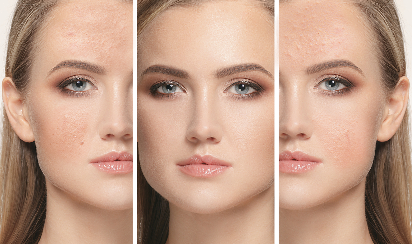 Les-9-meilleurs-traitements-contre-les-cicatrices-d'acné-recommandés-par-les-dermatologues.